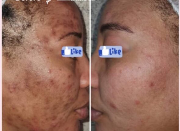 Acne, Stretch marks, Keloid, Bumps management, Non surgical laser Liposuction, Body Contouring, Sculpting machines8 - Copy