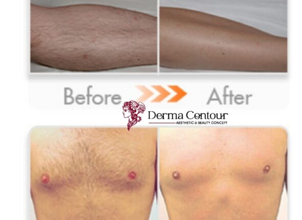 Cavitation, Cool Body Sculpting, Forming, Firming machine, Fat reduction devices, Skin tightening for saggy skin, derma contour2