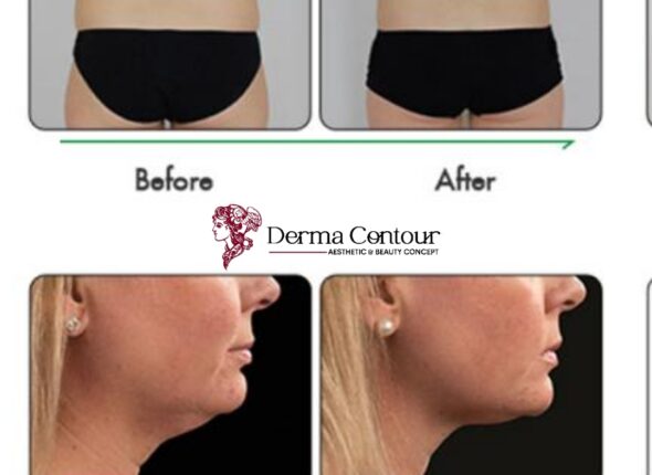 Cavitation, Cool Body Sculpting, Forming, Firming machine, Fat reduction devices, Skin tightening for saggy skin, derma contour3