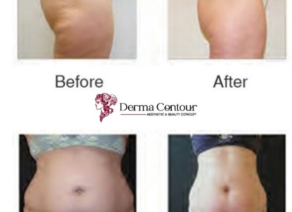 derma contour, laser skin care, laser skin treatment, cosmetic treatments, home skin laser, dermatology, professional skin treatment,1