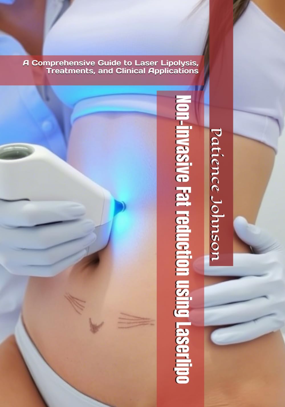 Non-invasive Fat reduction using Laserlipo Paperback By Patience Johnson